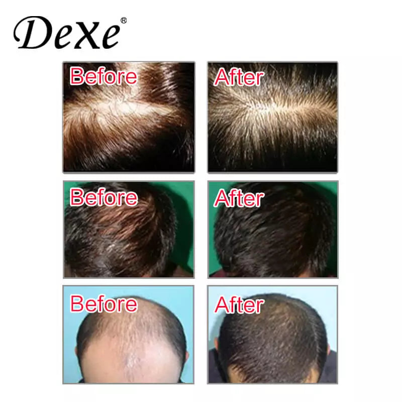 Dexe Anti-Hair Loss Shampoo 7oz Stop Hair Loss & Regrowth For Textured Hair