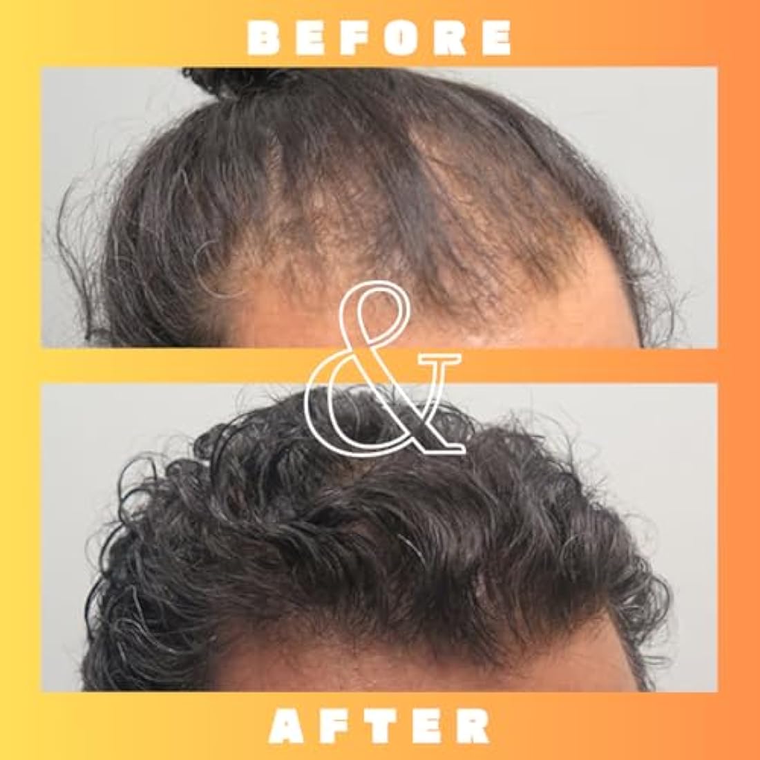 Mettle Mane - RU58841 5% Solution (50mg/ml) - DHT Blocker Hair Serum - 30ml Bottle