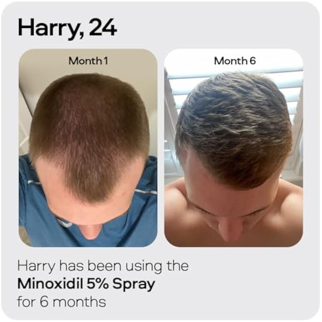 Sons Minoxidil 5% Cutaneous Solution for Men, Hair Regrowth & Thickener Formula, For Hair Loss & Thinning, Reactivates Shrunken Follicles, Precision Application System, 1 Month Supply Made in Europe