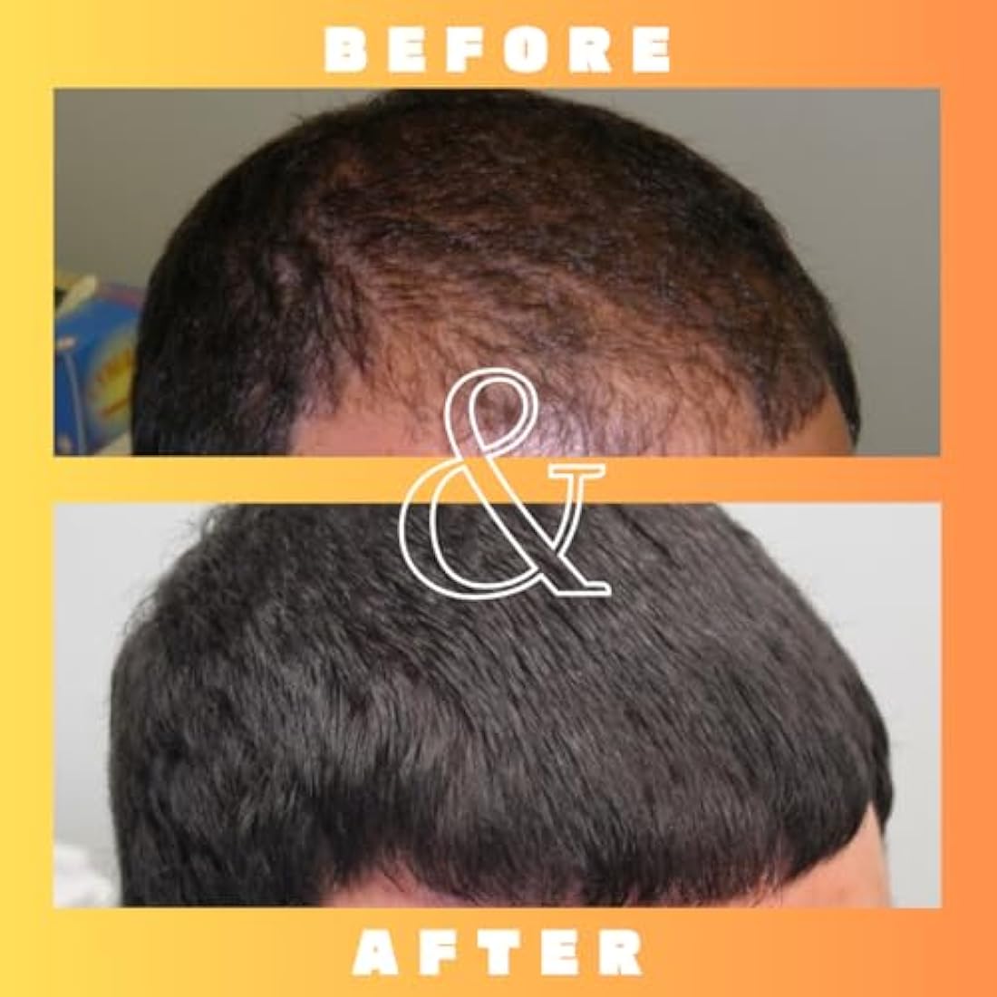 Mettle Mane - RU58841 5% Solution (50mg/ml) - DHT Blocker Hair Serum - 30ml Bottle