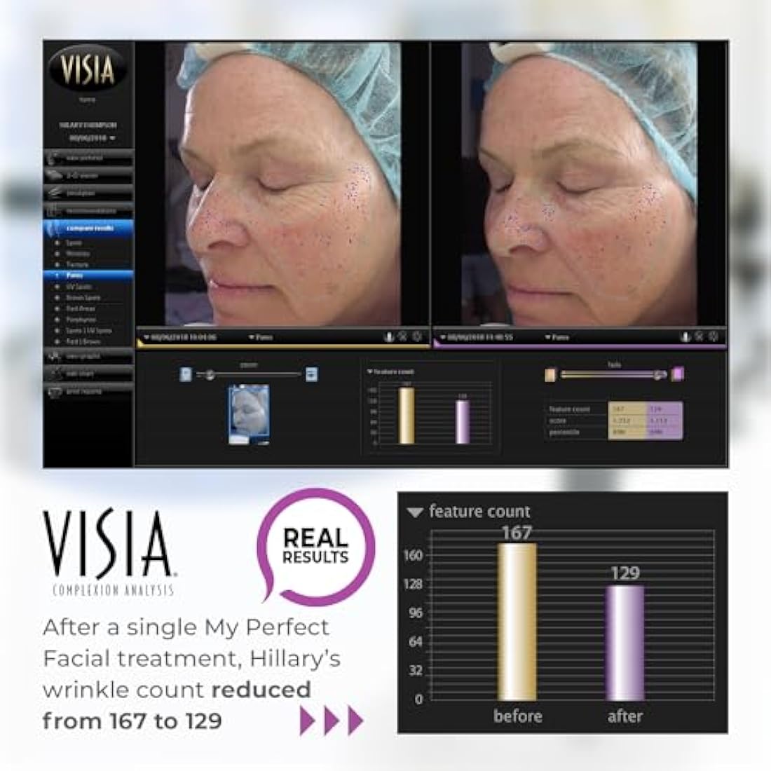 My Perfect Facial, Penny Lane, 10 Treatment Kit, Instant Results, Clinically Proven, Anti-Ageing 3-Stage Facial Contouring and Skin Tightening System. Salon Grade Results, As Seen on TV.
