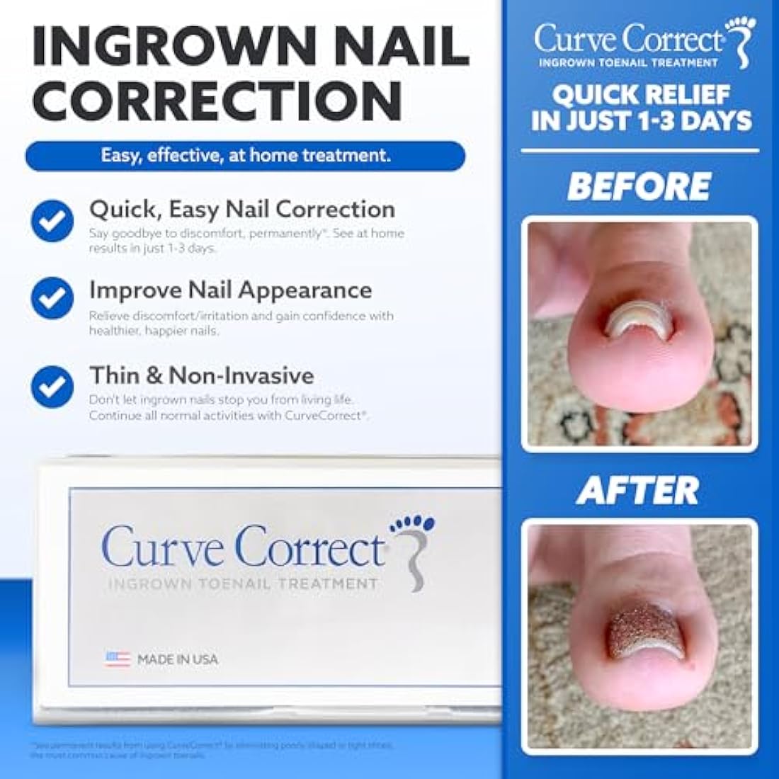 CurveCorrect Ingrown Toenail Home Treatment