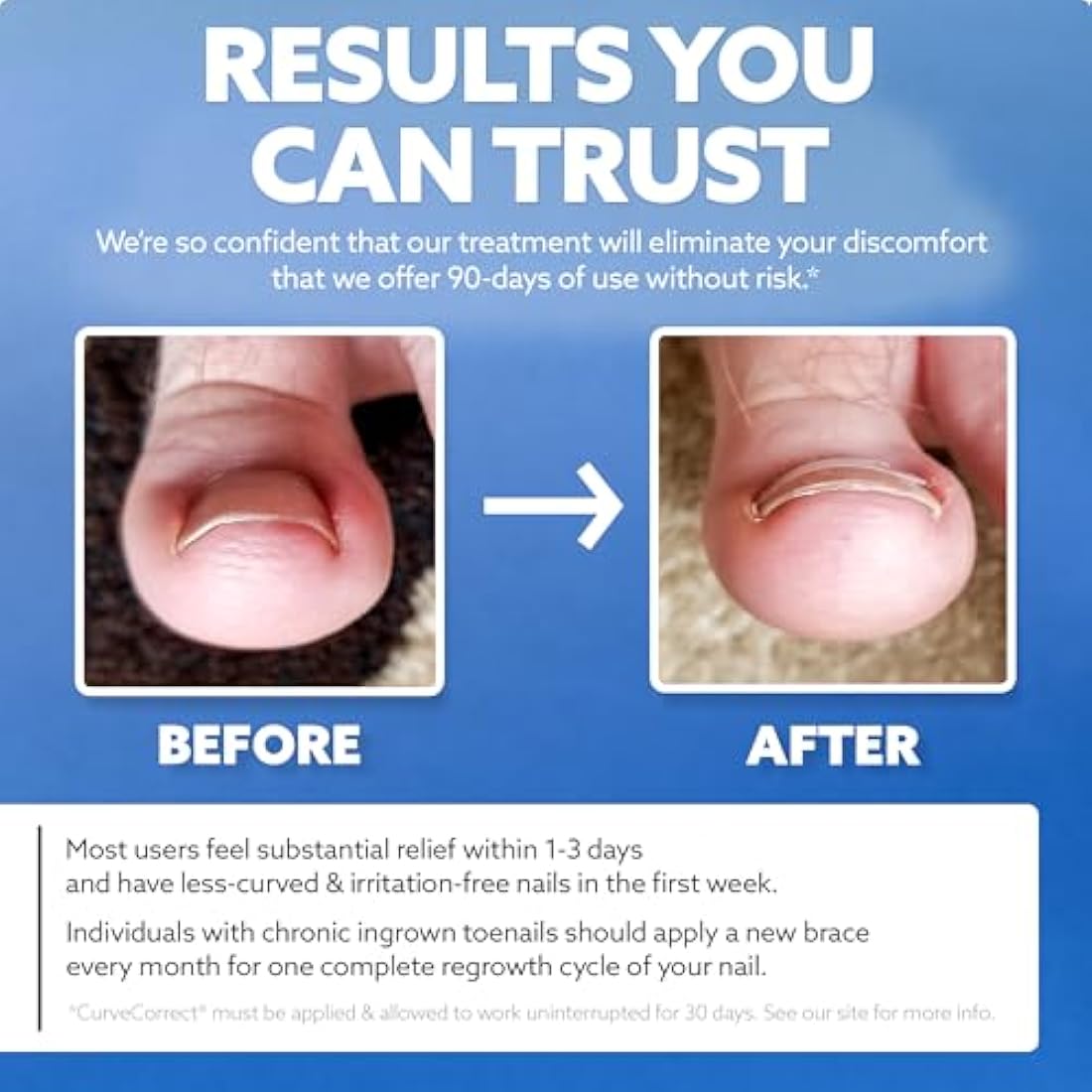 CurveCorrect Ingrown Toenail Home Treatment