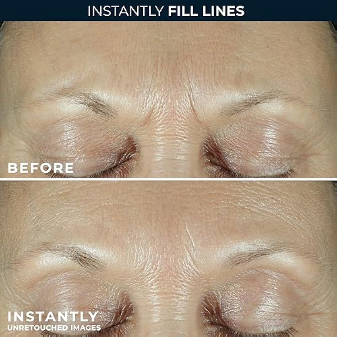 RoC Derm Correxion Serum Fill + Treat for Face, Neck, & Jawline, Wrinkle Filler, Advanced Retinol & Triple Hyaluronic Acid - 15ml