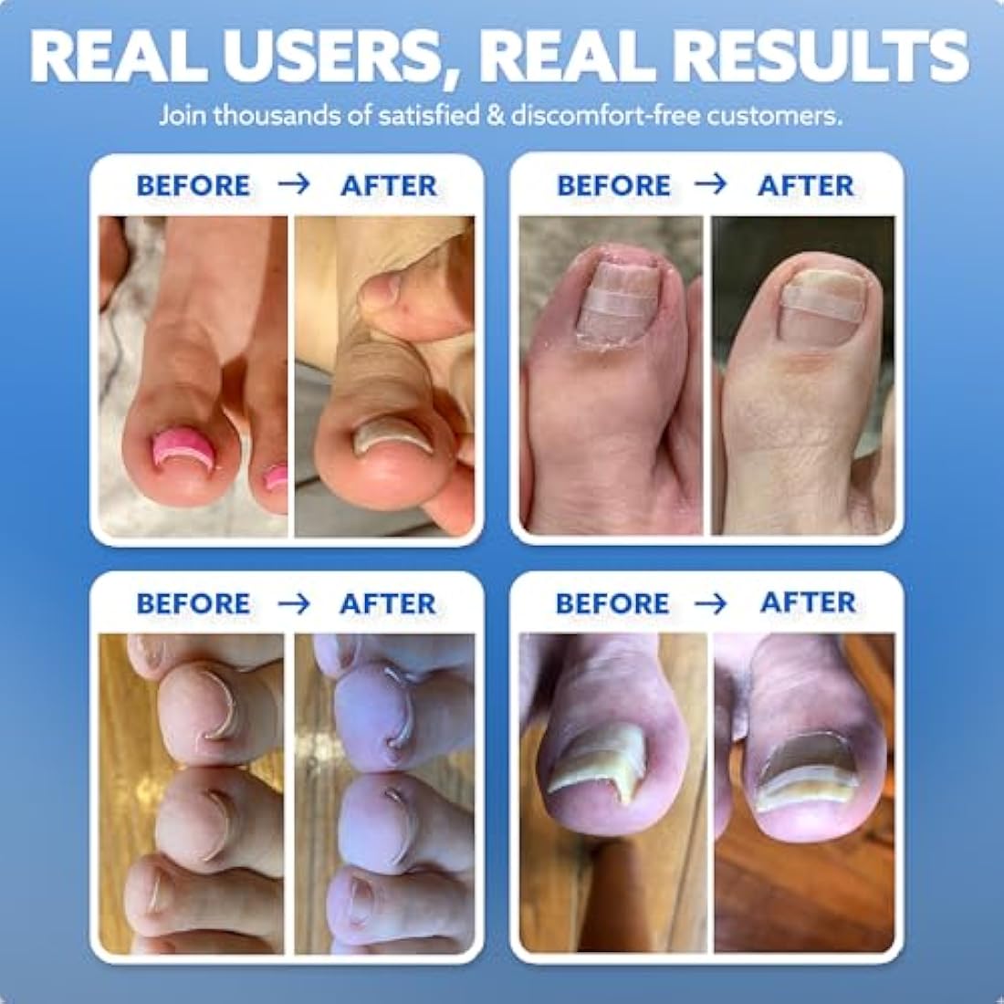 CurveCorrect Ingrown Toenail Home Treatment