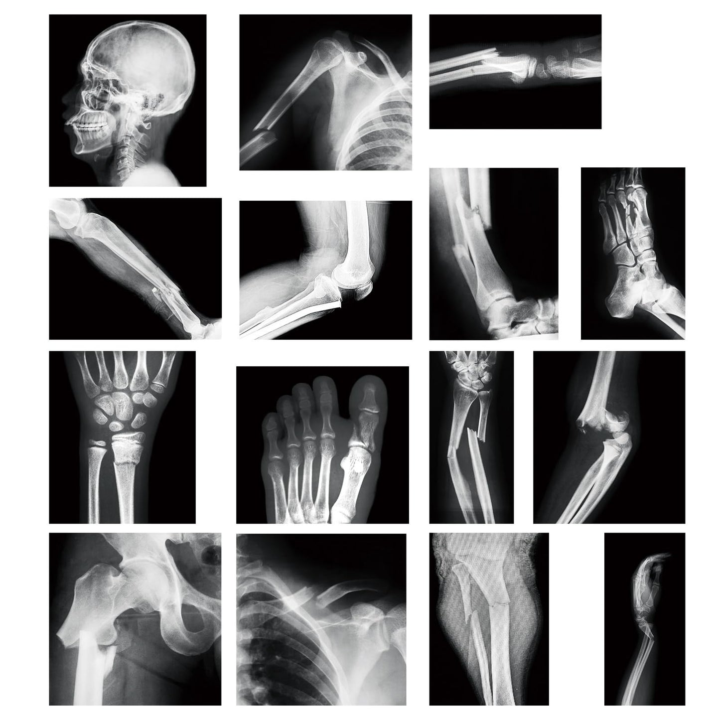 Sayglossy 15 Pcs Broken Bones X-Ray Set for Kids — Realistic PVC Skeleton X-Rays