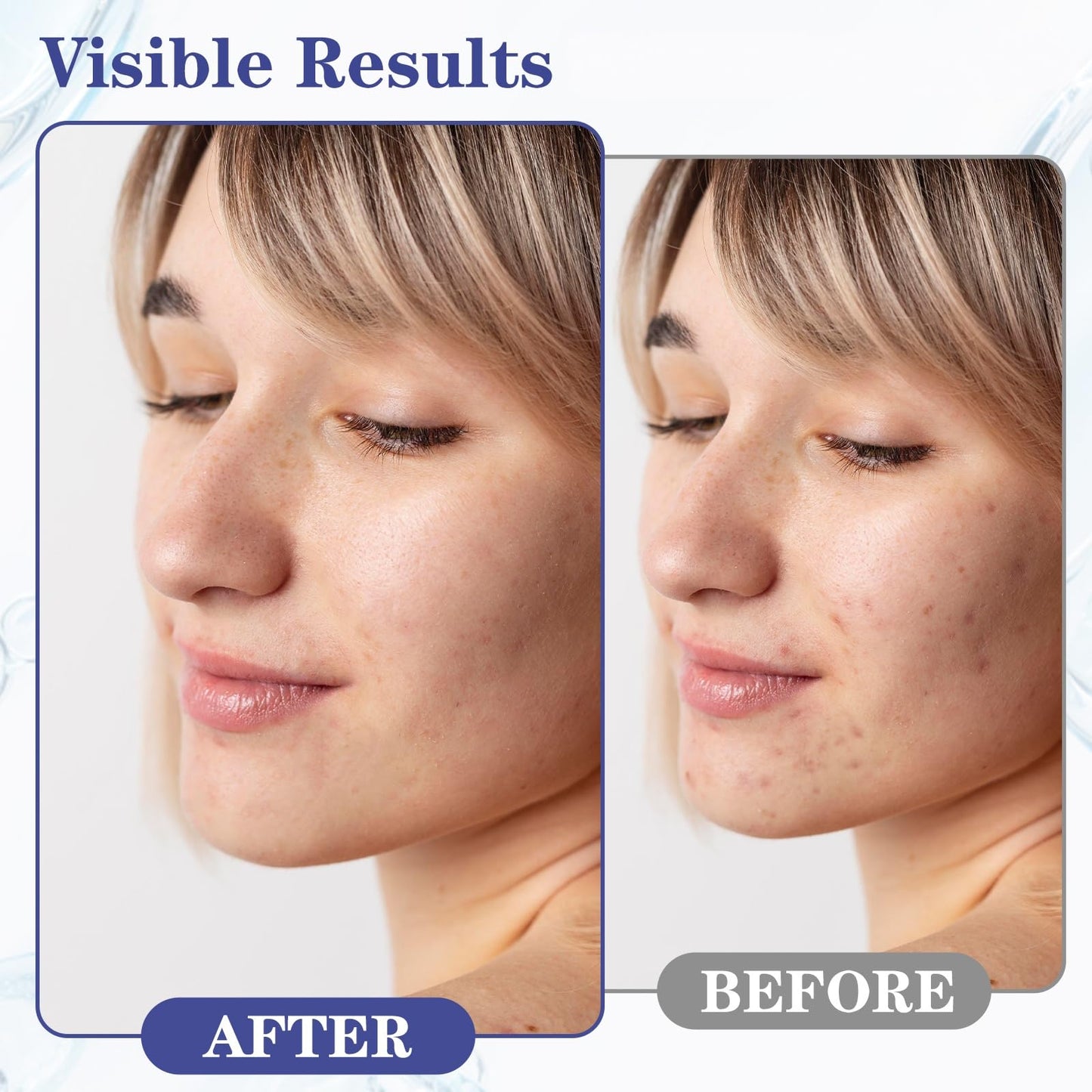 SINPIN aobenz Control Gel – 2% Salicylic Acid & Botanical Extracts for Face & Body